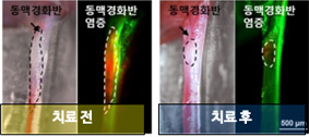 나노입자 기반 동맥경화 영상진단 및 치료​​ 표